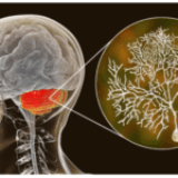Il targeting dell’atassina-3 mutante con oligonucleotidi antisenso può migliorare la disfunzione del neurone di Purkinje